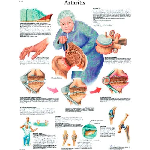 Centerline Dynamics Anatomical Models & Charts Anatomical Chart - Arthritis, Laminated