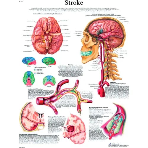 Centerline Dynamics Anatomical Models & Charts Anatomical Chart - Stroke Chart, Laminated