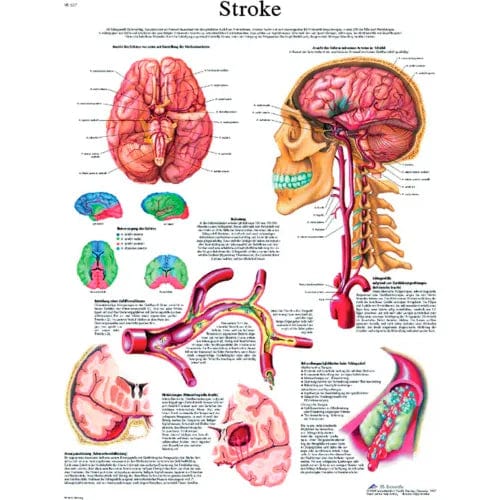 Centerline Dynamics Anatomical Models & Charts Anatomical Chart - Stroke Chart Paper