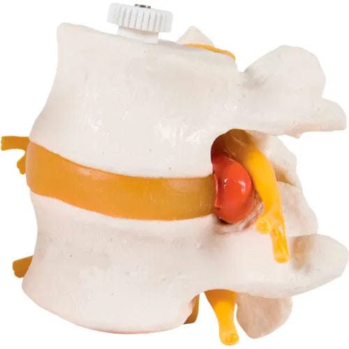 Centerline Dynamics Anatomical Models & Charts Anatomical Model - 2 Lumbar Vertebrae with Prolapsed Disc, Flexibly Mounted