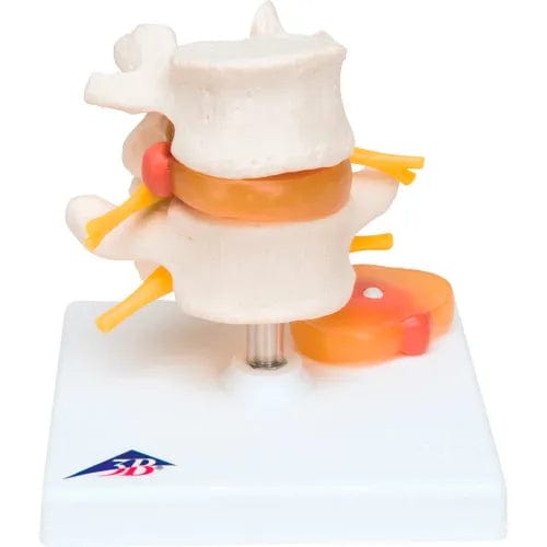 Centerline Dynamics Anatomical Models & Charts Anatomical Model - Lumbar Spinal Column with Prolapsed Intervertebral Disc