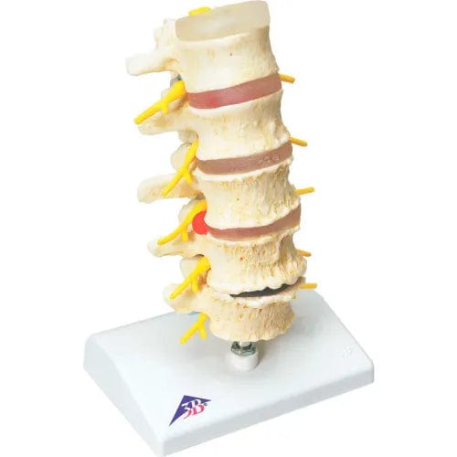 Centerline Dynamics Anatomical Models & Charts Anatomical Model - Vertebrae Degeneration, Stages of Prolapsed Disc
