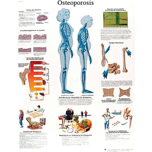 Centerline Dynamics Anatomical Models & Charts Anatomical Chart - Osteoporosis, Laminated