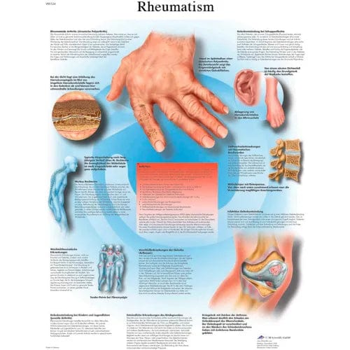 Centerline Dynamics Anatomical Models & Charts Anatomical Chart - Rheumatic Diseases, Laminated