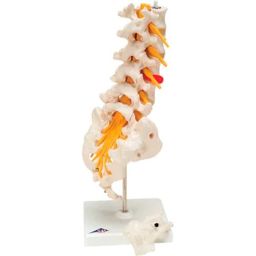 Centerline Dynamics Anatomical Models & Charts Anatomical Model - Lumbar Spinal Column with Dorso-Lateral Prolapsed Disc